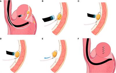 Efficacy and feasibility of snare-assisted endoscopic resection of small submucosal gastric tumors: A retrospective analysis